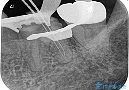 奥歯がズキズキ痛い 根管治療の治療中