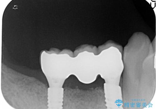 奥歯がなくなり咬めない インプラント治療による咬み合わせの回復の治療後
