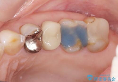 放置した虫歯　根管治療　フルジルコニアクラウンの症例 治療前
