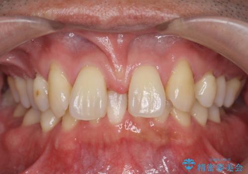 オールセラミッククラウン 部分矯正とセラミックによる前歯部の見た目の改善の治療前