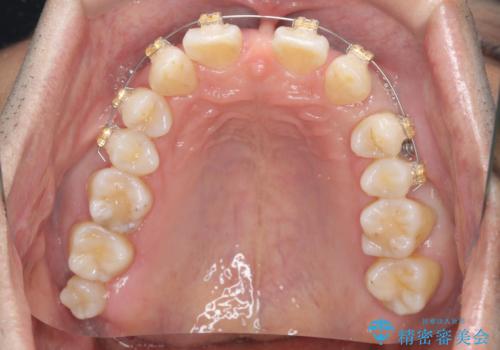 オールセラミッククラウン 部分矯正とセラミックによる前歯部の見た目の改善の治療中