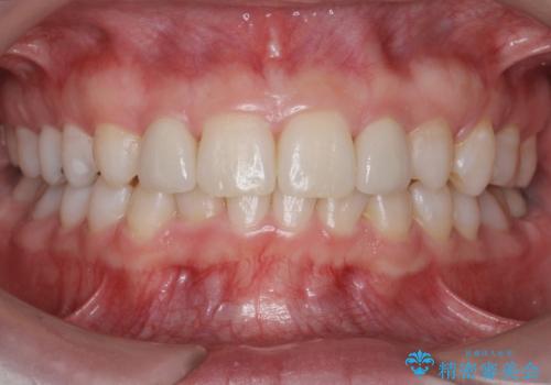 前歯を整えたい　小さい前歯がある　矯正・セラミック併用で美しく　インビザラインでも抜歯矯正できますの症例 治療後