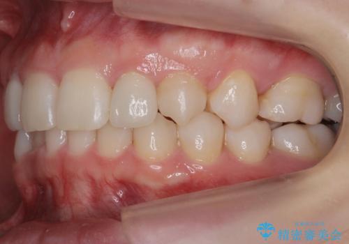 前歯を整えたい　小さい前歯がある　矯正・セラミック併用で美しく　インビザラインでも抜歯矯正できますの治療後