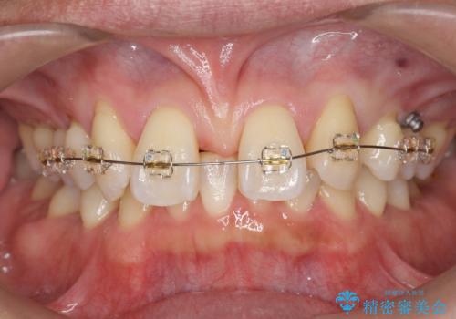 オールセラミッククラウン　部分矯正とセラミックによる前歯部の見た目の改善の治療中