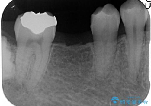 初めてのインプラント 手術は怖いので、寝ている間に終わりたいの治療前