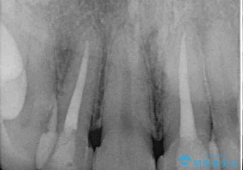 欠けてしまった前歯のセラミック 同じ色合いで再製作の治療前