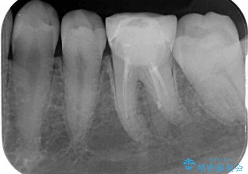 形が気に入らない 奥歯のオールセラミッククラウンの治療前