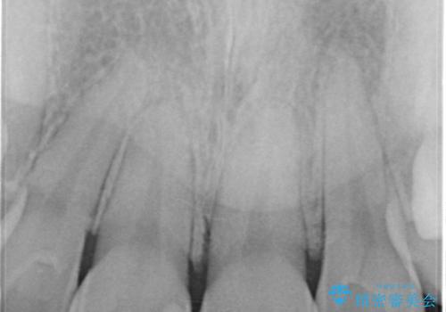 何度も欠けてしまう前歯を被せ物で治療の治療前
