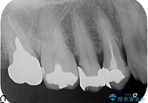 オールセラミッククラウン 変色した歯を白くの治療前