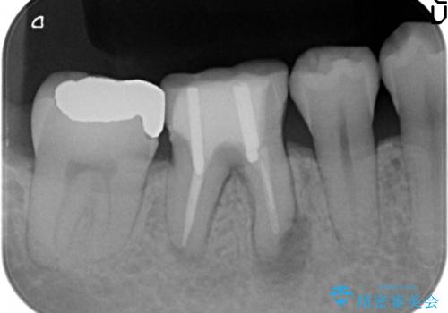 オールセラミッククラウン 膿が出続ける根の治療の治療前