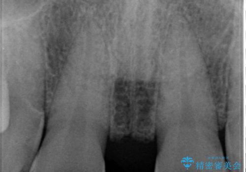 オールセラミッククラウン 部分矯正とセラミックによる前歯部の見た目の改善の治療前
