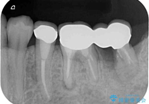 痛みを感じる奥歯 根管治療とインプラント治療の治療前