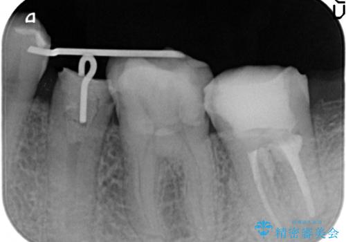 オールセラミッククラウン　歯の挺出・歯周外科による歯茎より深い虫歯の治療の治療中