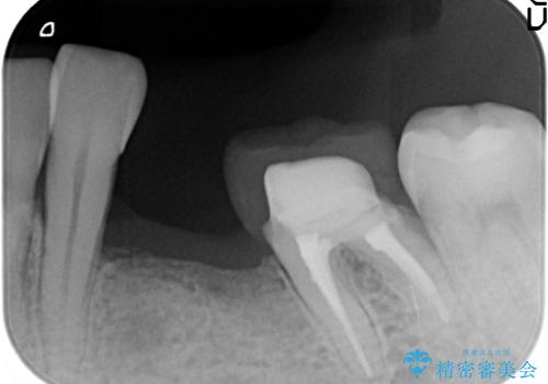 インプラント 左下奥歯の咬み合わせの改善の治療前