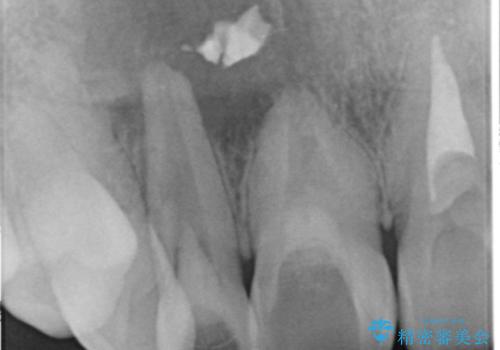 [根管治療・セラミッククラウン]  他院で抜くしかないと言われた歯の治療の治療中