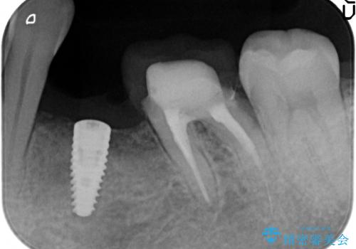 インプラント 左下奥歯の咬み合わせの改善の治療後