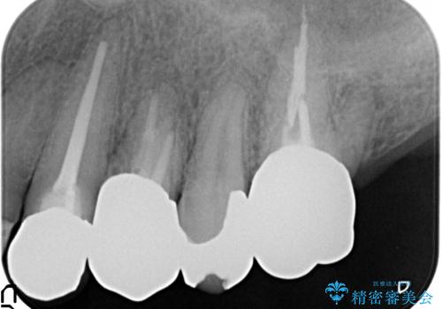 PGA(ゴールド)クラウン 脱離した銀歯の治療の治療後