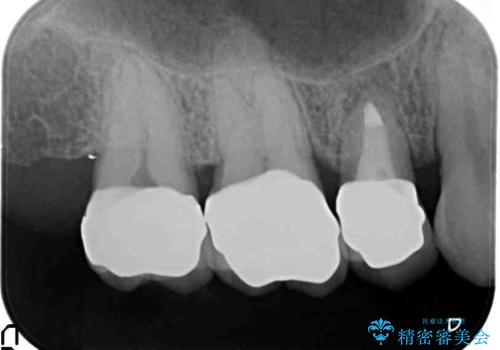 口の中の金属を外したい　セラミッククラウンによる治療の治療後