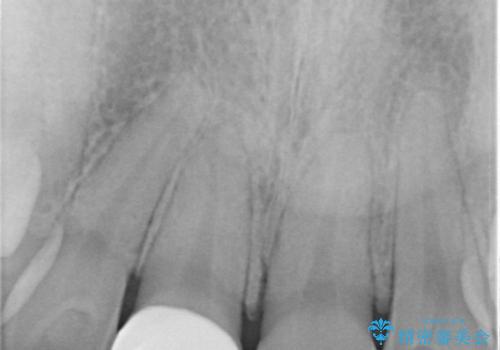 何度も欠けてしまう前歯を被せ物で治療の治療後