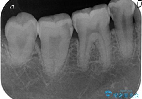 オールセラミッククラウン セラミックインレー しみる奥歯の治療の治療前