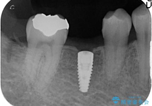 初めてのインプラント 手術は怖いので、寝ている間に終わりたいの治療中