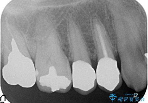 オールセラミッククラウン 変色した歯を白くの治療後