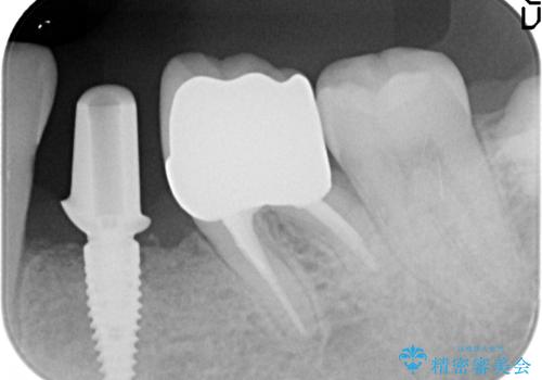 インプラント 左下奥歯の咬み合わせの改善の治療中