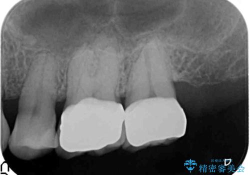 口の中の金属を外したい　セラミッククラウンによる治療の治療後