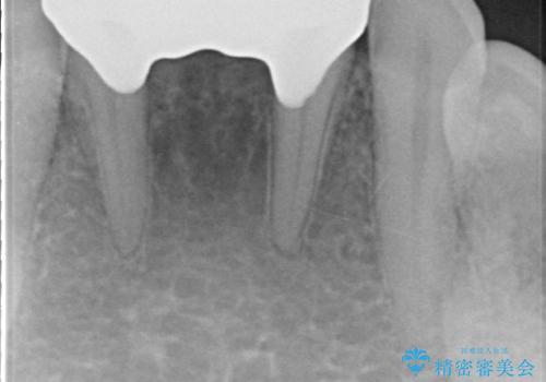 前歯の保険のブリッジ 欠けてしまったのをやり直したいの治療後