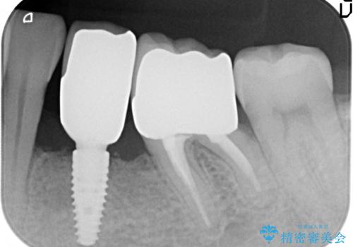 インプラント 左下奥歯の咬み合わせの改善の治療後