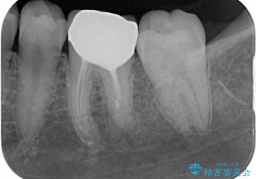 形が気に入らない 奥歯のオールセラミッククラウンの治療後
