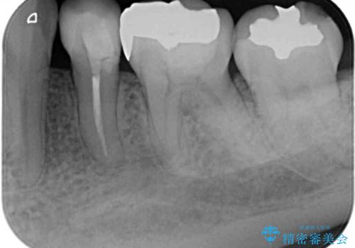 矯正の後戻りの改善と銀歯をセラミックにの治療前