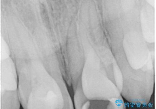 前歯が黒い セラミックで綺麗に 20代女性の治療前