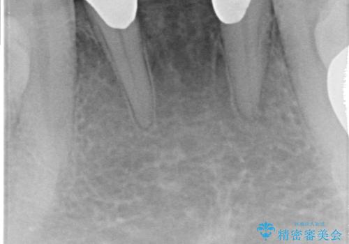 前歯の保険のブリッジ 欠けてしまったのをやり直したいの治療前