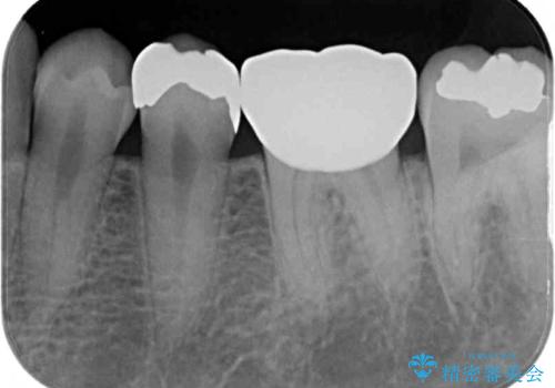 保険診療で装着した奥歯の白いクラウン 痛みが続くためセラミッククラウンへの治療後