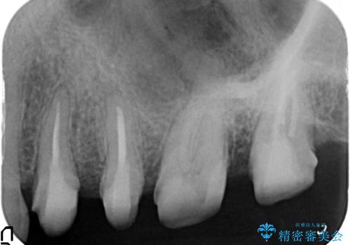 放置した虫歯 根管治療 フルジルコニアクラウンの治療中