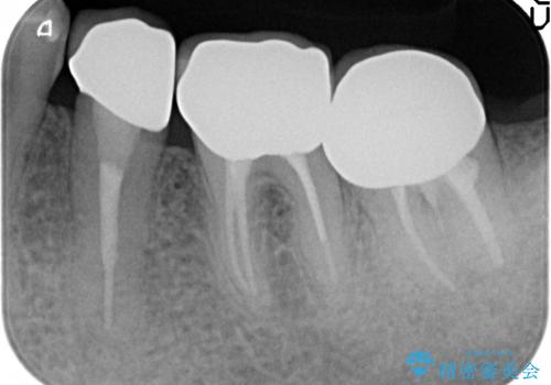 オールセラミッククラウン　歯の挺出・歯周外科による歯茎より深い虫歯の治療の治療後