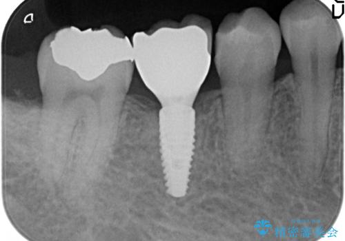 初めてのインプラント 手術は怖いので、寝ている間に終わりたいの治療後