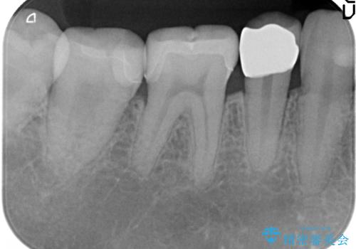 オールセラミッククラウン セラミックインレー しみる奥歯の治療の治療後
