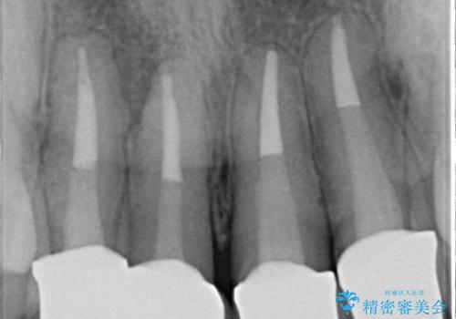 老朽化した前歯のセラミック治療やりかえの治療後