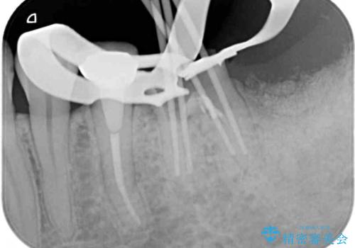 痛みを感じる奥歯 根管治療とインプラント治療の治療中
