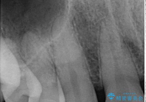 オールセラミッククラウン 部分矯正とセラミックによる前歯部の見た目の改善の治療前