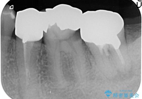 オールセラミッククラウン 歯の挺出・歯周外科による歯茎より深い虫歯の治療の治療前