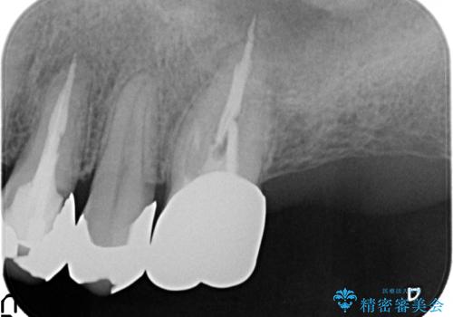PGA(ゴールド)クラウン 脱離した銀歯の治療の治療前