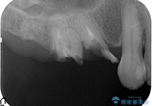 奥歯がなくなり咬めない インプラント治療による咬み合わせの回復の治療前