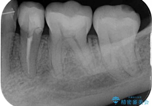 矯正の後戻りの改善と銀歯をセラミックにの治療後