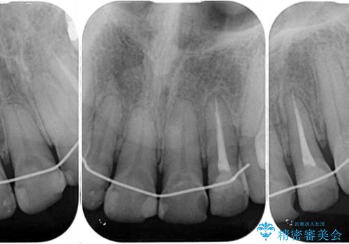 矯正しても虫歯が気になる 前歯のオールセラミッククラウンの治療前