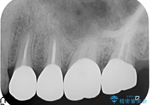 放置した虫歯 根管治療 フルジルコニアクラウンの治療後