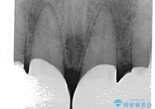 オールセラミッククラウン 部分矯正とセラミックによる前歯部の見た目の改善の治療後