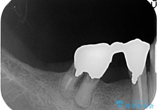 奥歯がなくなり咬めない　インプラント治療による咬み合わせの回復の治療前